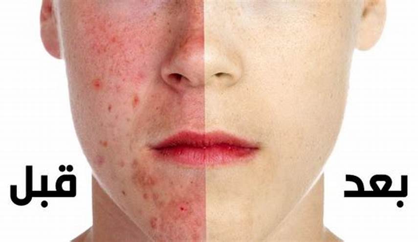 تجربتي مع كريم فيوسيدين لحب الشباب والتخلص الفوري منه