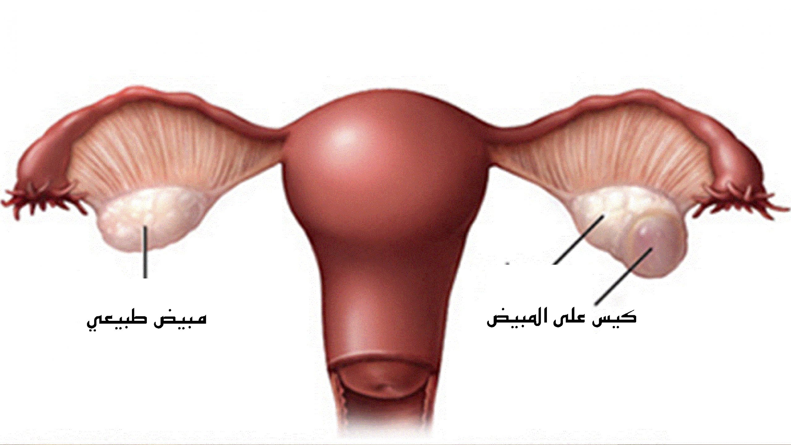 تجربتي مع نزول كيس على المبيض وطرق التخلص منه