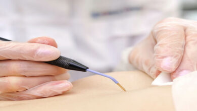 تجربتي مع الكي وأبرز فوائده، وما مدة الشفاء بعد اجرائه وعلامات نجاح الكي؟